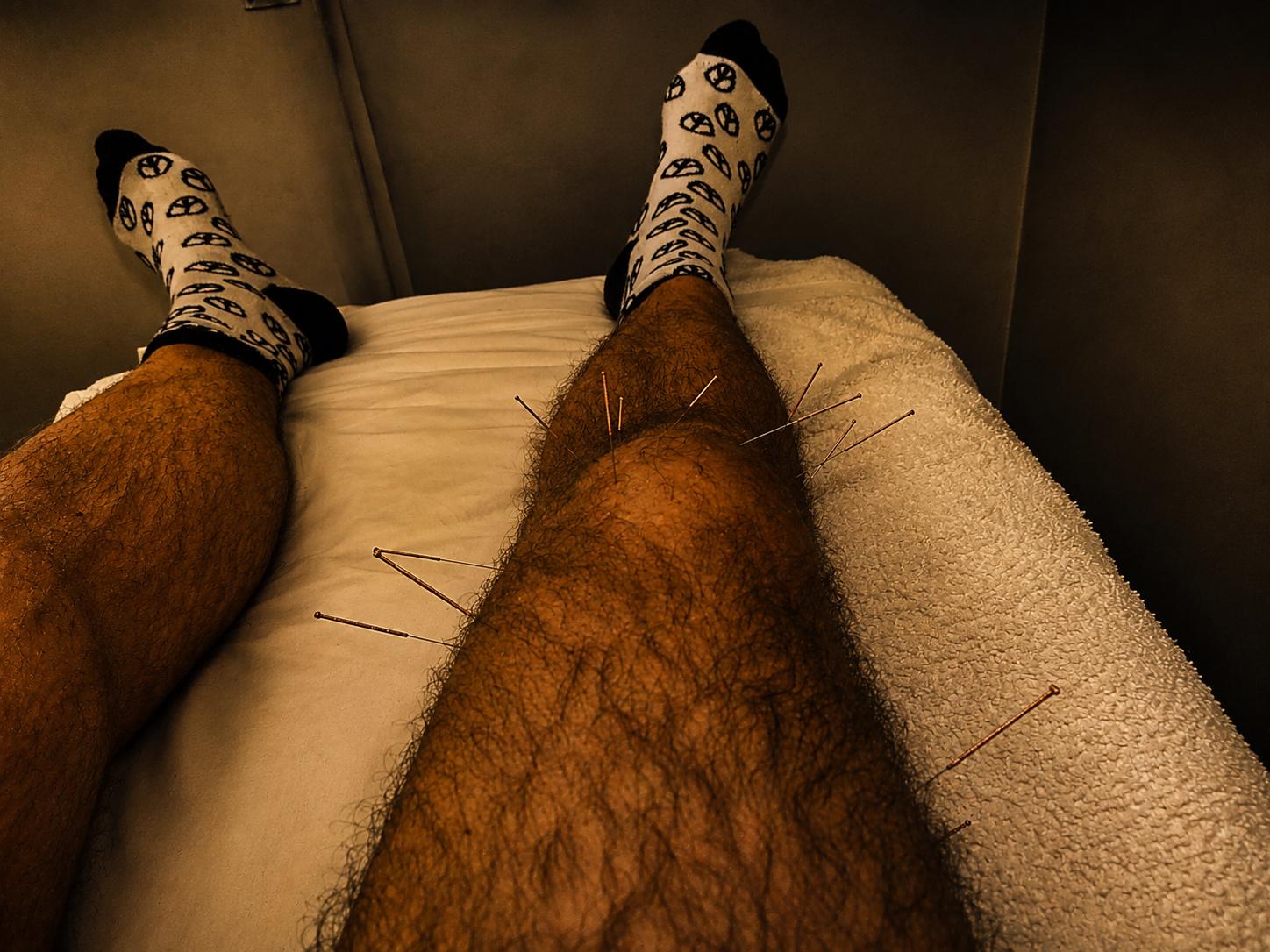 Tom Acupuncture Treatment